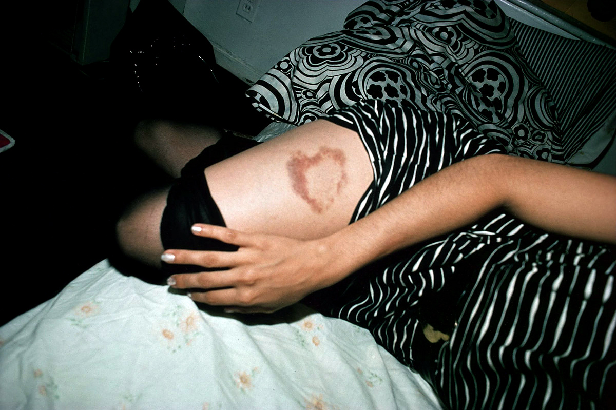 Heart-Shaped Bruise
