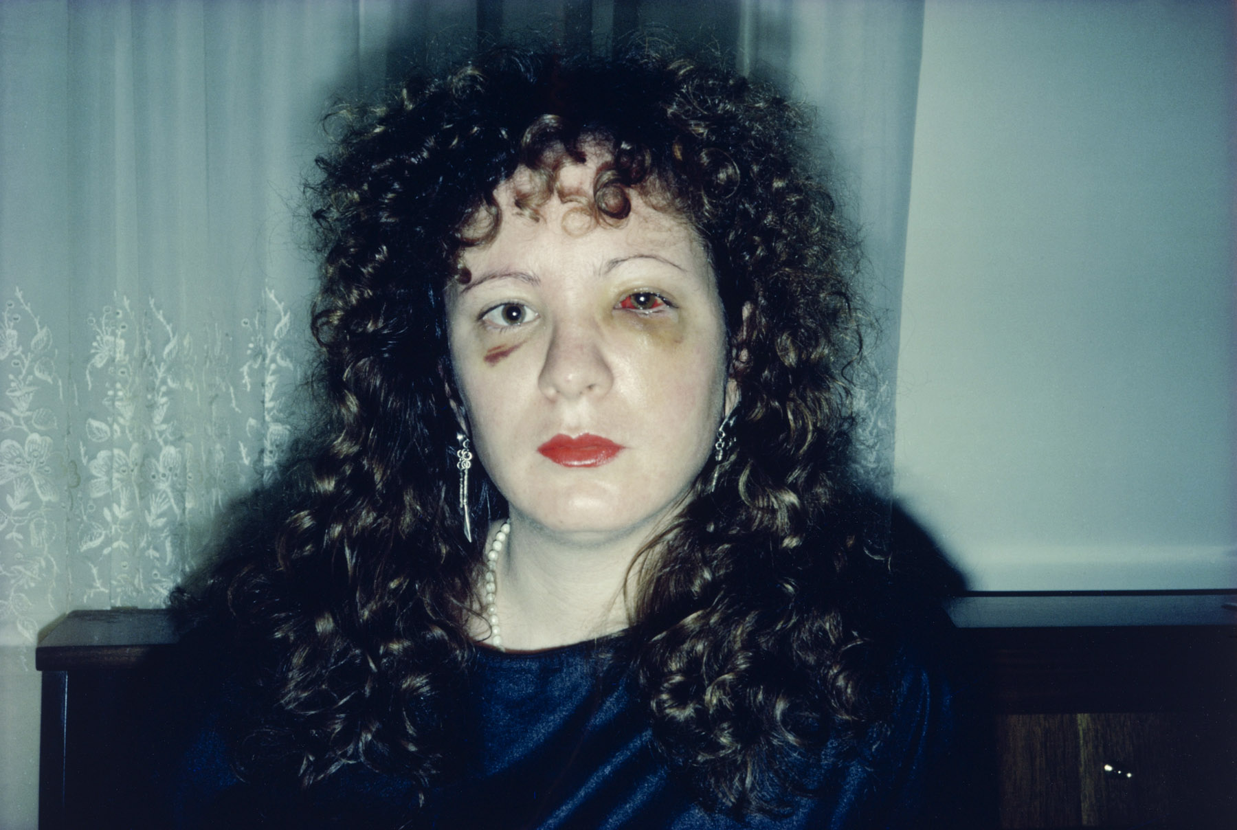 Nan One Month After Being Battered, 1984